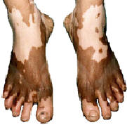 Vitiligo