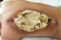 Postradiační nekróza kůže