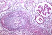 Fibróza arteriální stěny