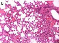 Postradiační změny v plicní tkáni