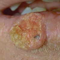 Spinaliom na dolním rtu