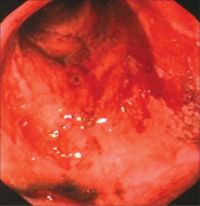 Radiační proktitida