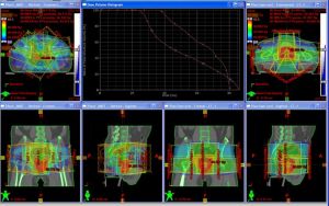 Ozařovací plán pro radioterapii v oblasti pánve